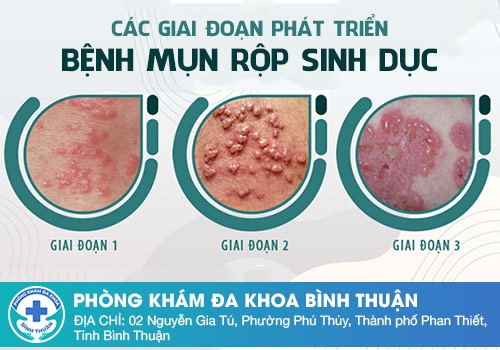 Mọc mụn nước âm đạo do bệnh mụn rộp sinh dục