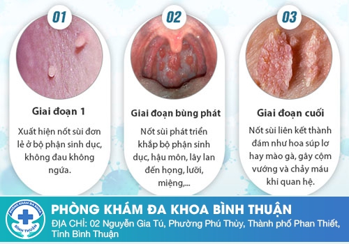 bệnh sùi mào gà ở nam giới