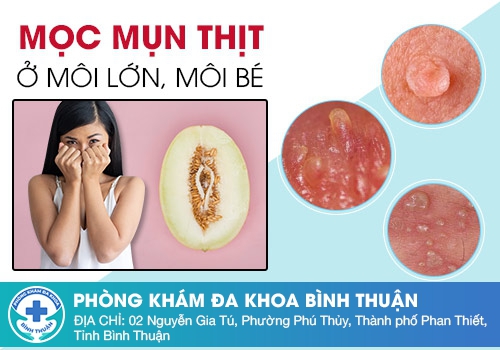 Xuất hiện thịt thừa vùng kín là bị gì?